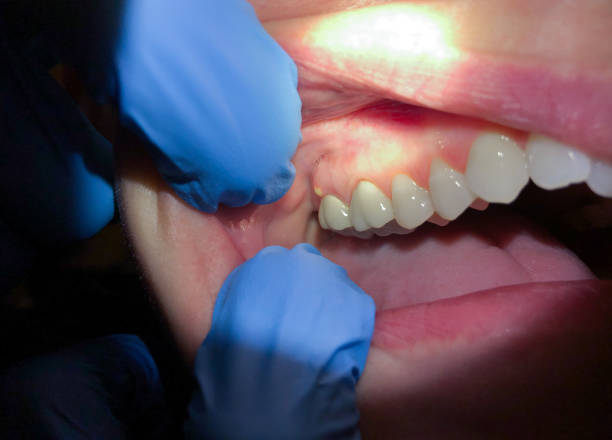 Best Urgent Care for Lost Fillings or Crowns in Onawa, IA