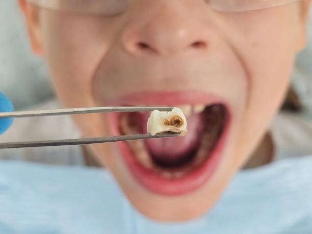 Best Emergency Dental Care for Broken or Chipped Teeth in Onawa, IA